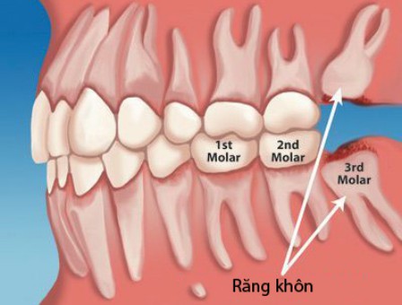 Chữa đau răng khôn