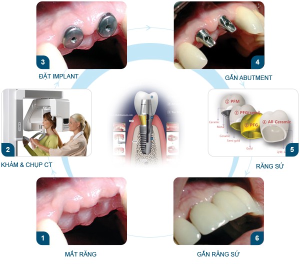 cong nghe implant nha khoa mikuni ha noi