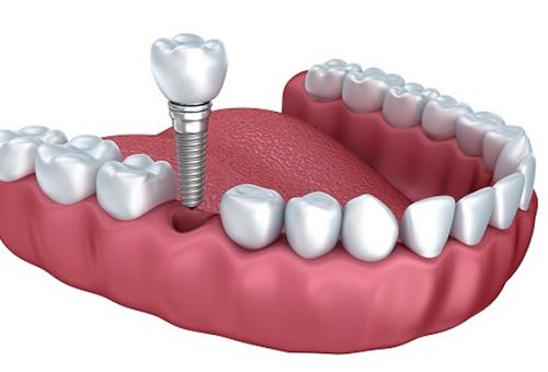 cong nghe implant nha khoa mikuni ha noi