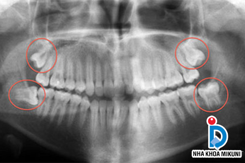 Răng khôn mọc khiến nhiều người đau nhức