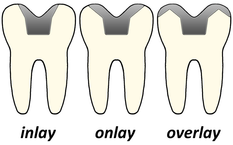 Tìm hiểu về inlay, onlay và overlay