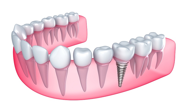 Cấy ghép răng theo phương pháp Implant