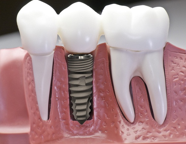 Phục hồi răng đã mất nhờ cấy ghép Implant