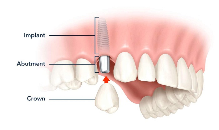 Kỹ thuật cấy ghép răng giả Implant